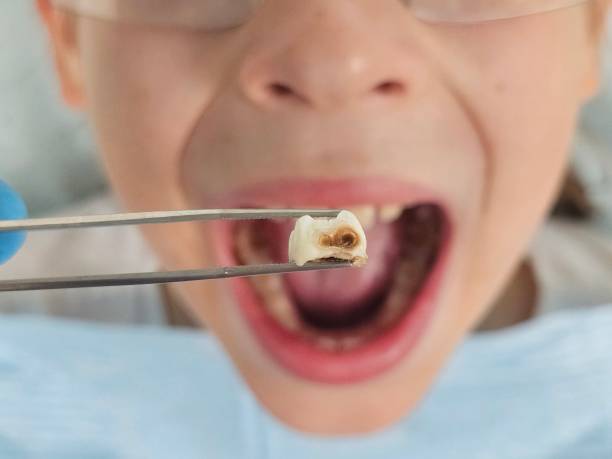 Best Emergency Dental Care for Abscessed Tooth in Lawrenceburg, TN